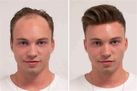 **Hair Replacement for Men: End the Hair Loss Battle**